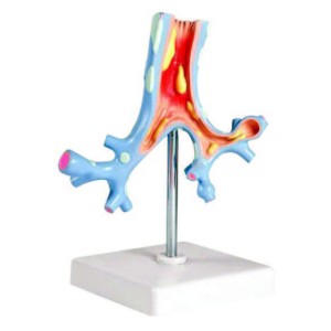 Pathological Model of the Bronchi